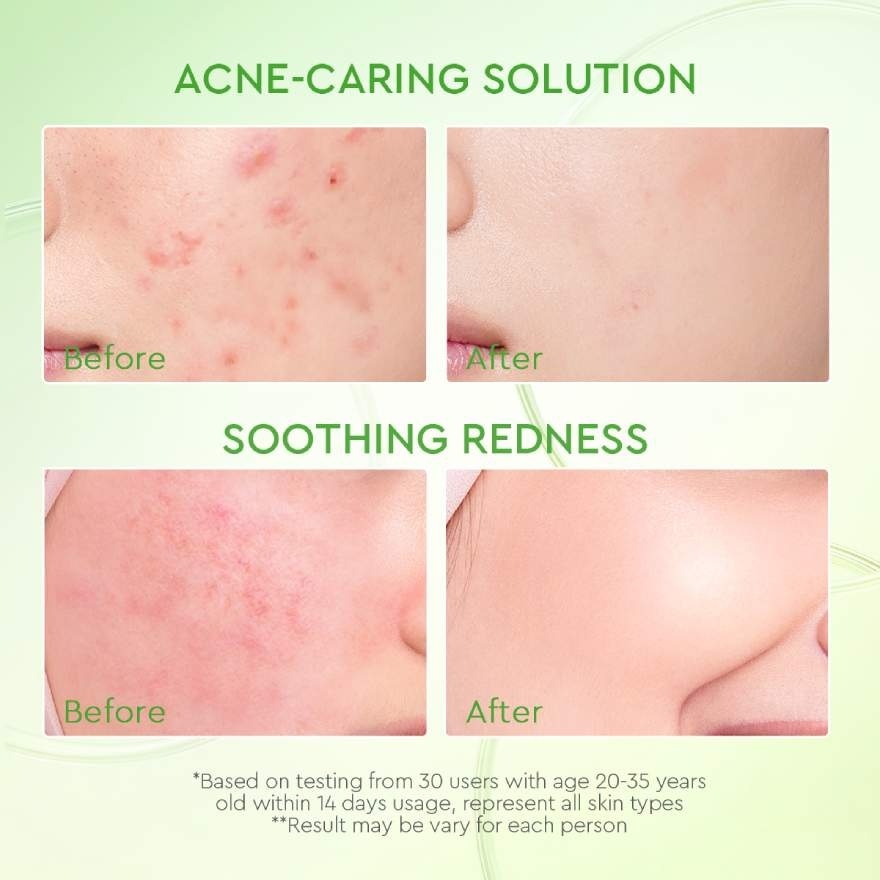 Kiwi 3D Acid Acne Moisturizer 30g
