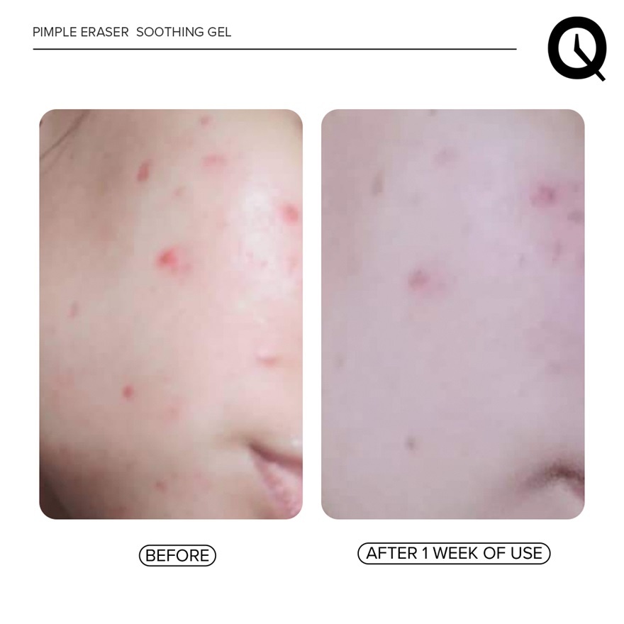 Pimple Eraser Soothing Gel 100ml