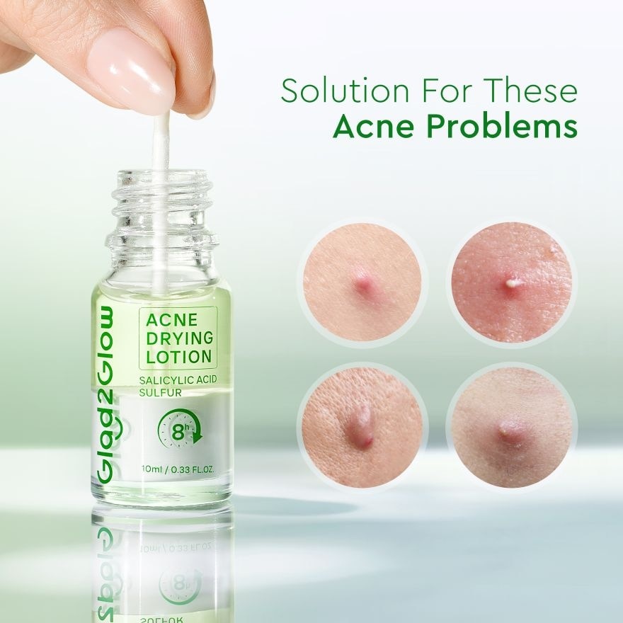 Acne Drying Lotion 10ml + Cotton Swab 20pcs