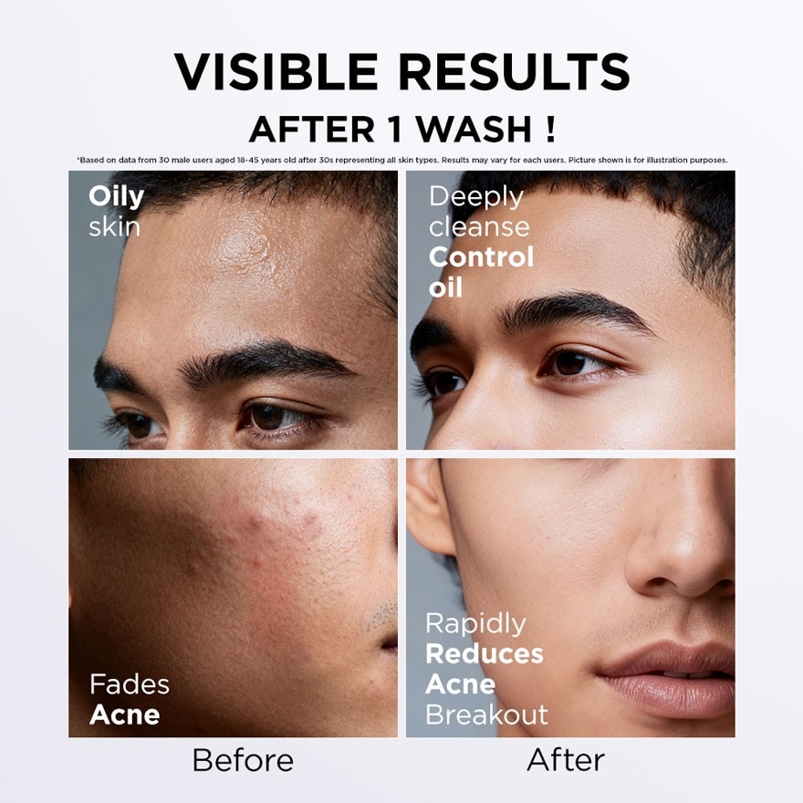 Acne Care Facial Wash 100g