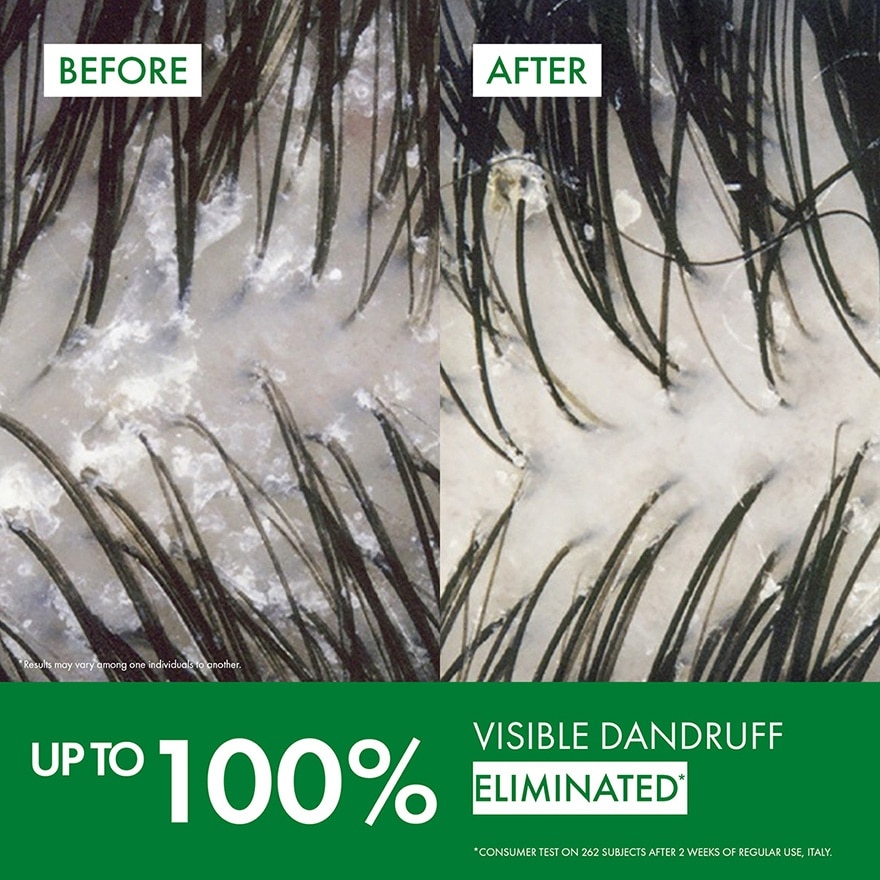 Anti-Dandruff Hair Shampoo 200ml (Normal to Oily hair)