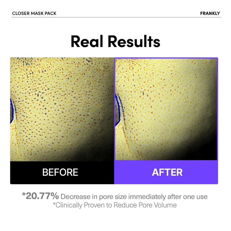 Closer Pore Minimizing Mask 1s