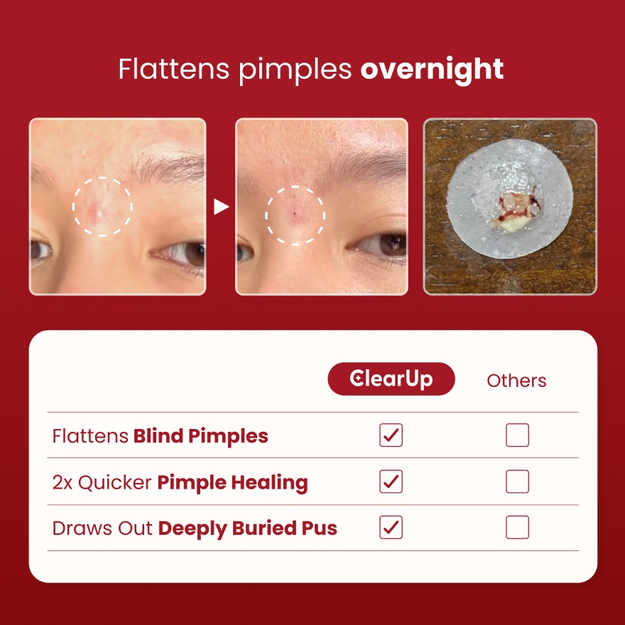 Microdarts for Acne 9s image