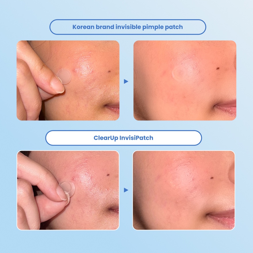 Invisipatch for Acne 18s image