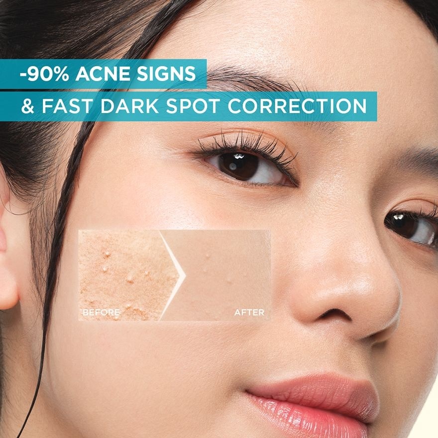 Bright Complete Anti Acne Serum 30ml