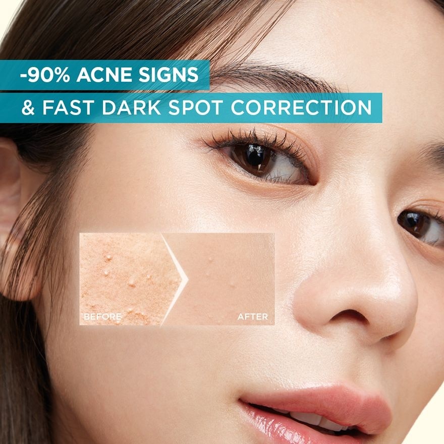Bright Complete Anti Acne Serum 30ml