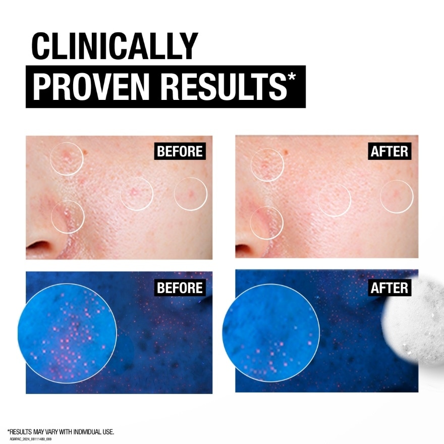 Deep Clean Acne Foam Cleanser 100g